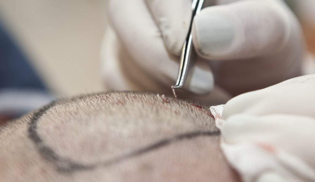 Pros And Cons Of An Afro Hair Transplant Procedure