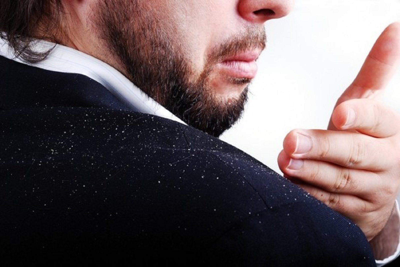 How To Control Dandruff
